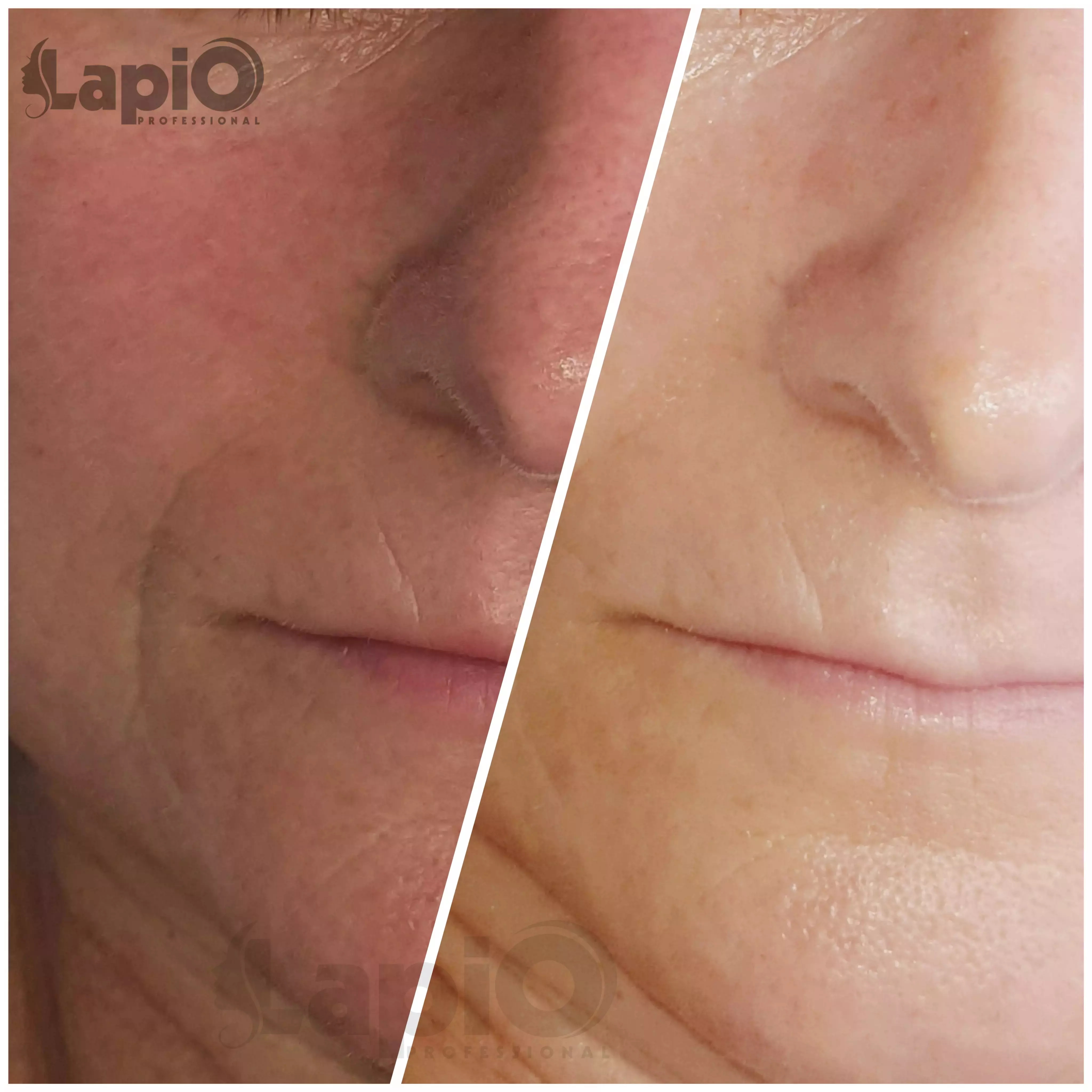 Urządzenie kosmetyczne VIP EDITION do oczyszczania wodorowego z 2 pojemnikami do infuzji | odpinane głowice - JEDEN KABEL wodor_1