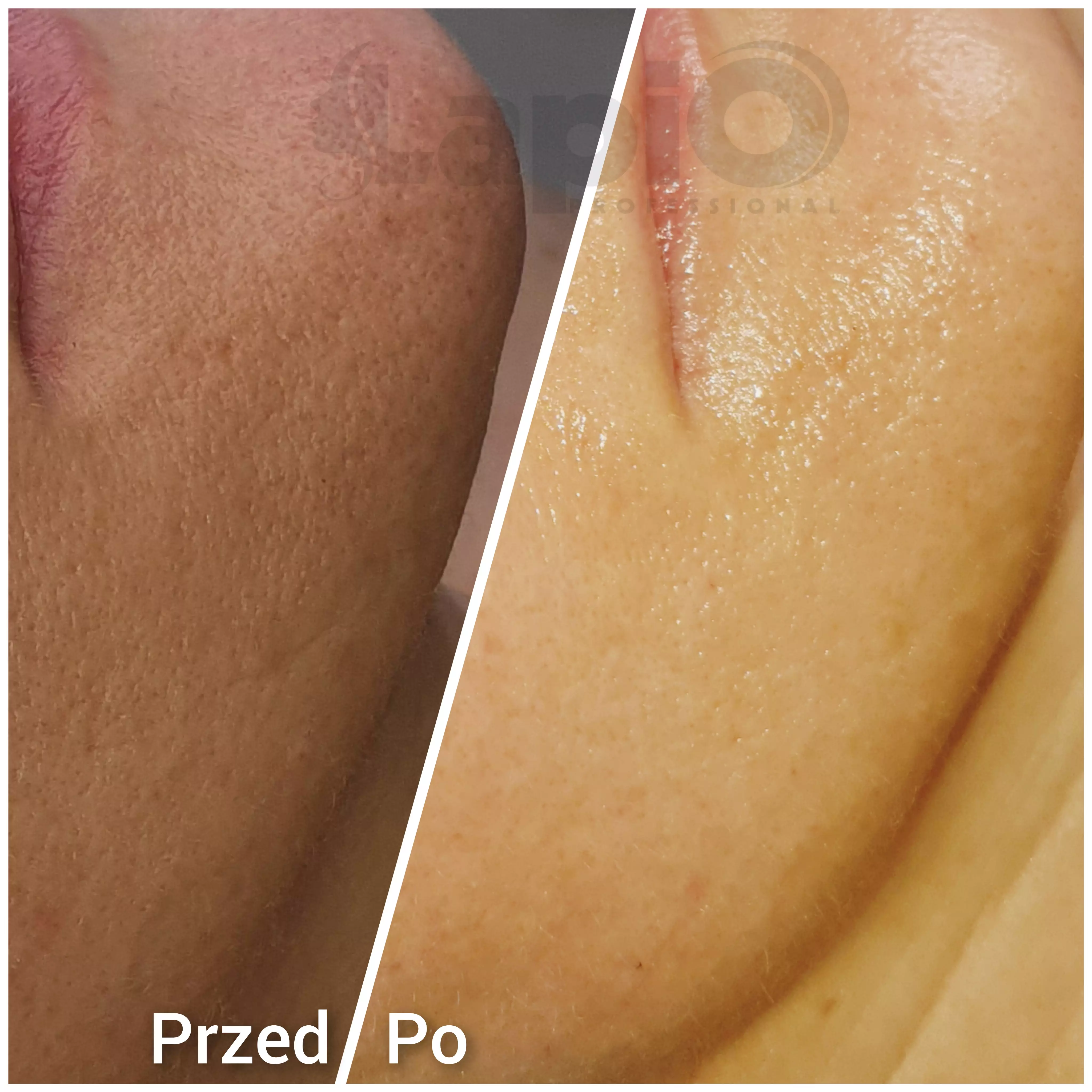 Urządzenie kosmetyczne VIP EDITION do oczyszczania wodorowego z 2 pojemnikami do infuzji | odpinane głowice - JEDEN KABEL wodor_2