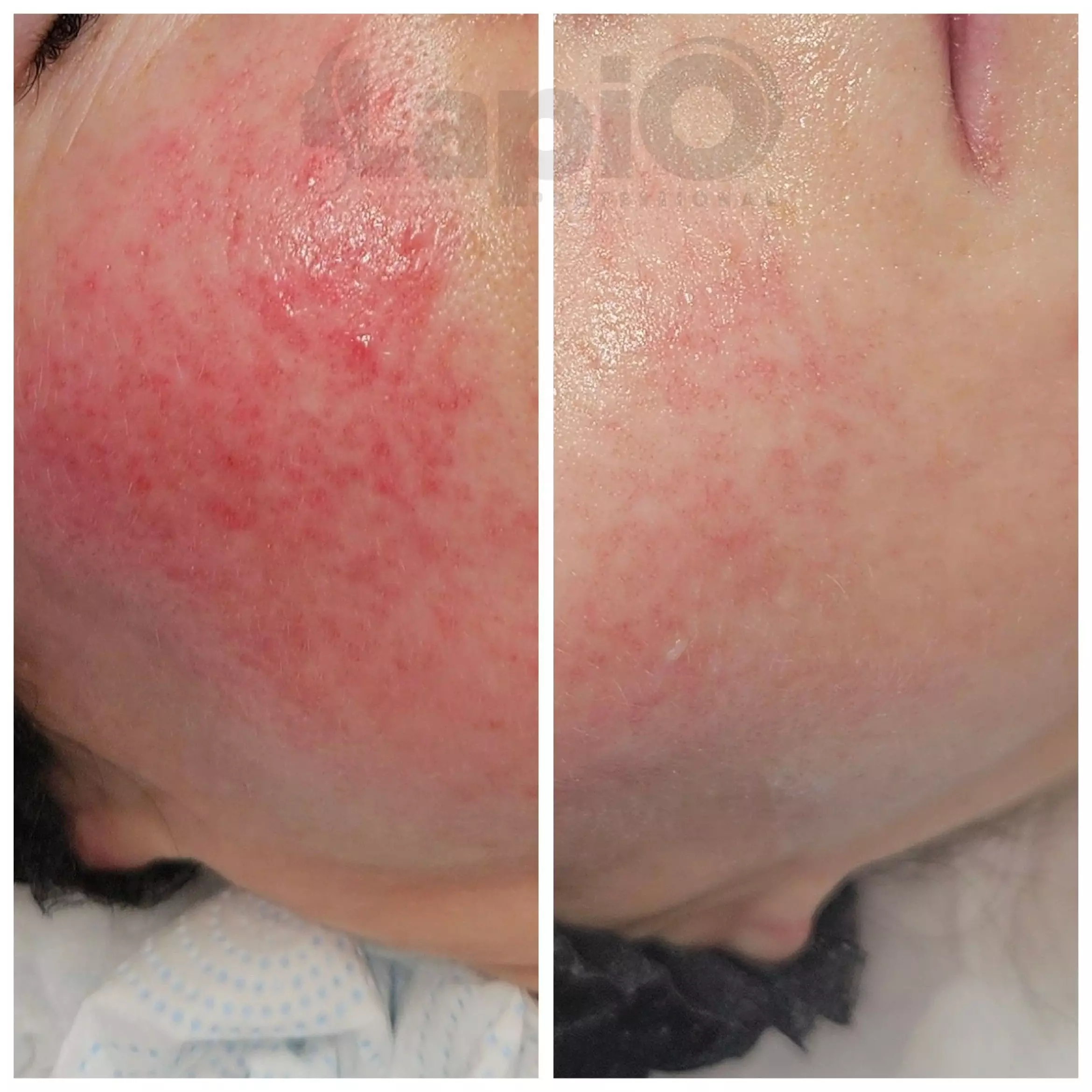 Urządzenie kosmetyczne VIP EDITION do oczyszczania wodorowego z 2 pojemnikami do infuzji | odpinane głowice - JEDEN KABEL wodor_3