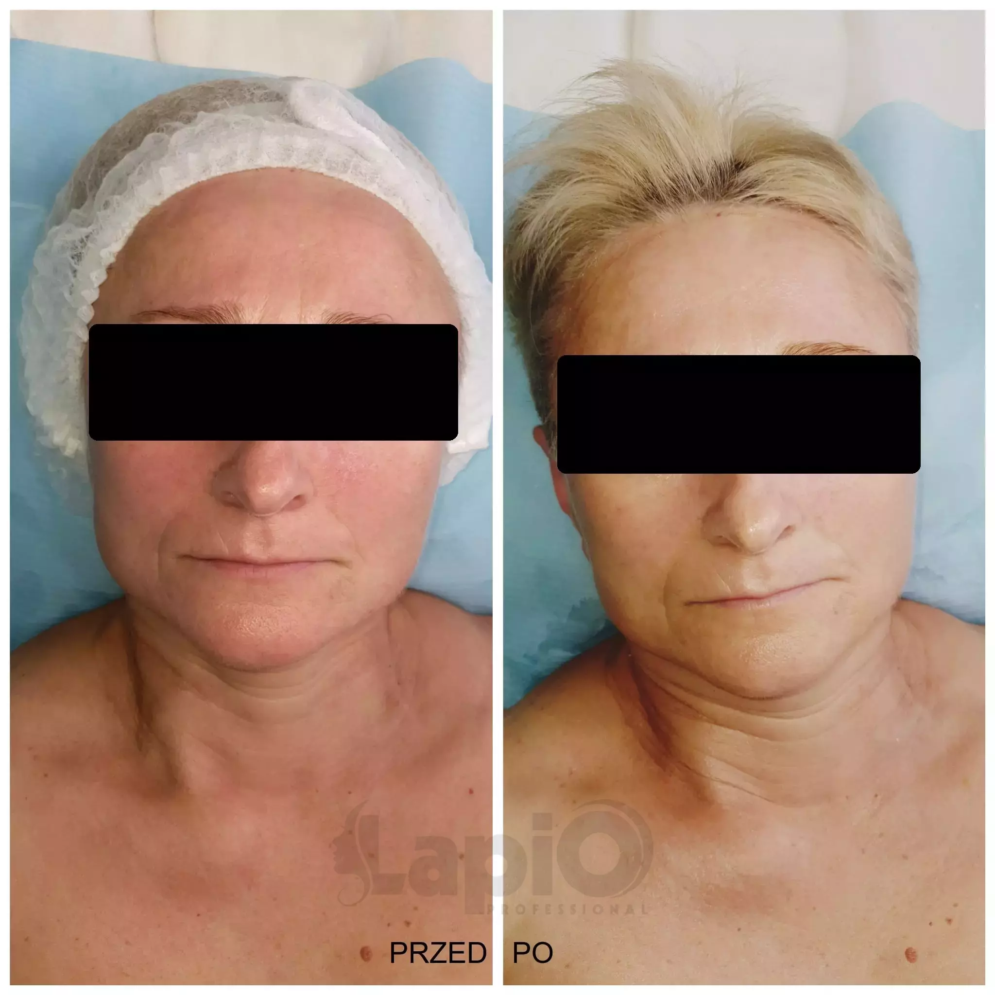 Urządzenie kosmetyczne VIP EDITION do oczyszczania wodorowego z 2 pojemnikami do infuzji | odpinane głowice - JEDEN KABEL wodor_4